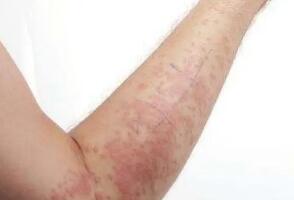 生活中常见的湿疹有哪些