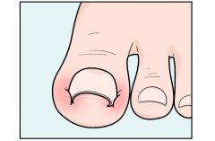 脚大拇指出现甲沟炎怎么治疗